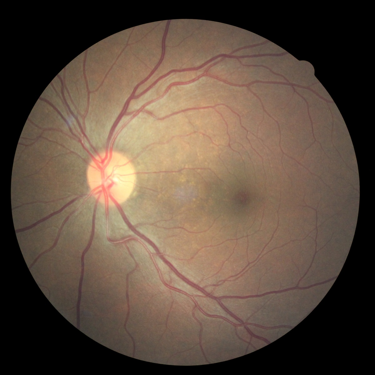 Diabetic Retinopathy Classification Using CNNs