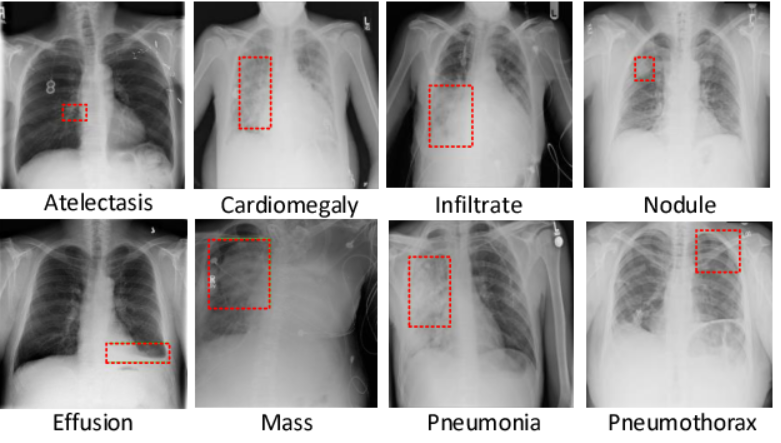 Lung Disease Detection